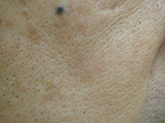症例12　脂漏性角化症（右頬のしみ）レーザー治療 治療後