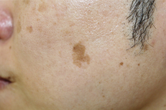 症例13　老人性色素斑（左頬のしみ）レーザー治療 治療前