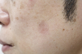 症例13　老人性色素斑（左頬のしみ）レーザー治療 治療後