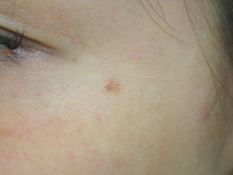 症例14　老人性色素斑（左目尻のしみ）レーザー治療 治療前