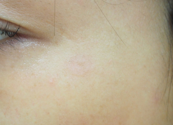 症例14　老人性色素斑（左目尻のしみ）レーザー治療 治療後
