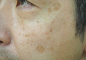症例16　老人性色素斑（両頬のしみ）レーザー治療 治療前