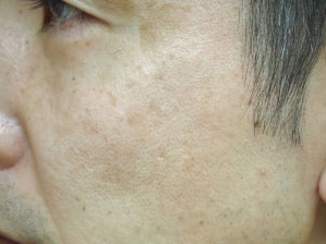 症例16　老人性色素斑（両頬のしみ）レーザー治療 治療後