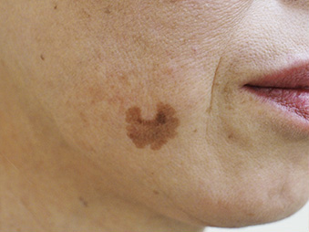 症例1　老人性色素斑（右頬のしみ）レーザー治療 治療前