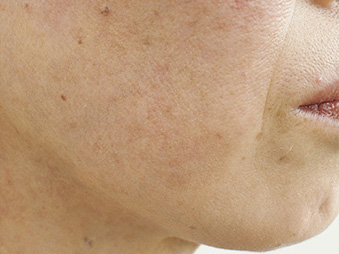 症例1　老人性色素斑（右頬のしみ）レーザー治療 治療後