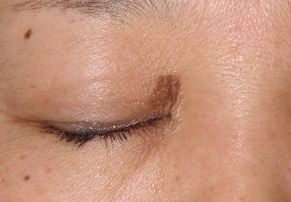 症例2　老人性色素斑（右まぶたのしみ）レーザー治療 治療前