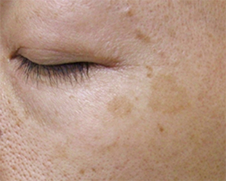症例3　老人性色素斑（左頬のしみ）レーザー治療 治療前