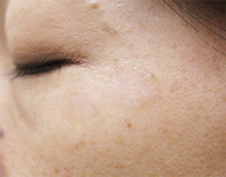 症例3　老人性色素斑（左頬のしみ）レーザー治療 治療後