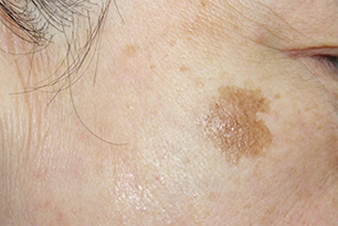 症例4　老人性色素斑（右頬のしみ）レーザー治療 治療前