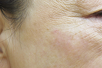 症例4　老人性色素斑（右頬のしみ）レーザー治療 治療後
