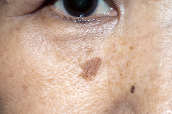症例8　老人性色素斑（右頬のしみ）レーザー治療 治療前