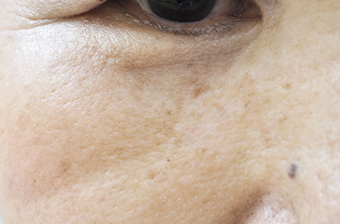 症例8　老人性色素斑（右頬のしみ）レーザー治療 治療後