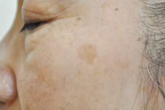 症例9　老人性色素斑（左頬のしみ）レーザー治療 治療前