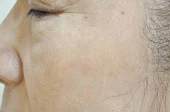 症例9　老人性色素斑（左頬のしみ）レーザー治療 治療後