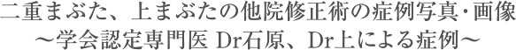 二重まぶた、上まぶたの他院修正術の症例写真・画像～学会認定専門医　Dr石原、Dr上による症例～