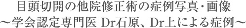 目頭切開の他院修正術の症例写真・画像～学会認定専門医　Dr石原、Dr上による症例～