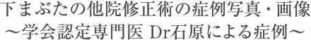 下まぶたの他院修正術の症例写真・画像～学会認定専門医　Dr石原による症例～