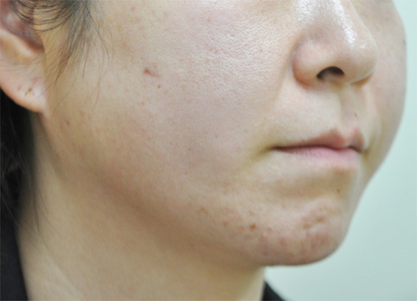 症例1　脂肪溶解注射とボトックス（えら） 治療前