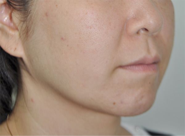 症例1　脂肪溶解注射とボトックス（えら） 治療後