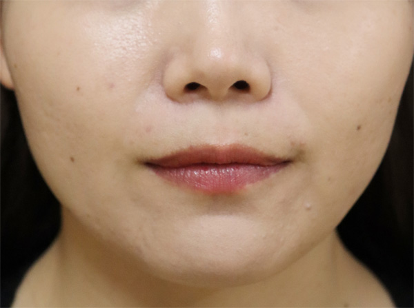 症例2　脂肪溶解注射とえら（小顔）ボトックス 治療後