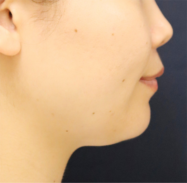 症例2　脂肪溶解注射とえら（小顔）ボトックス 治療前
