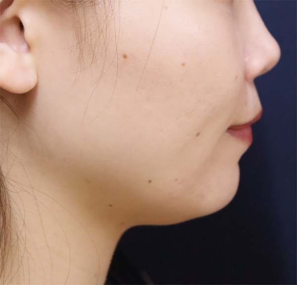 症例2　脂肪溶解注射とえら（小顔）ボトックス 治療後