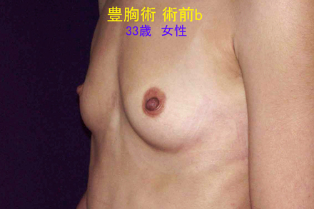 症例1術前b年.jpg