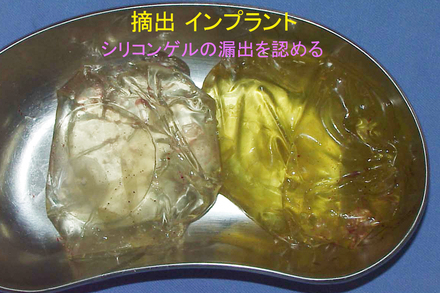 症例6摘出インプラント.jpg