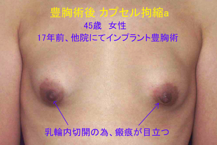 症例6術前a.jpg