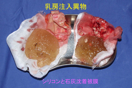 症例11摘出物.jpg