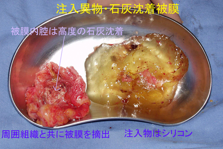 症例8摘出物.jpg
