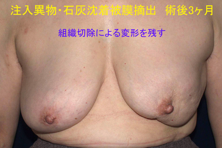 症例8術後3ヶ月.jpg