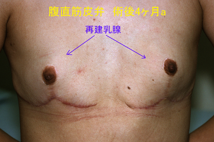症例3再手術後a.jpg