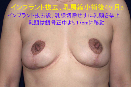症例7術後a.jpg