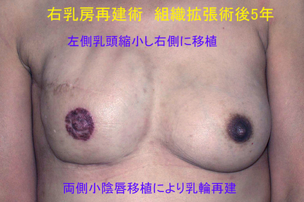 症例2術後5年.jpg