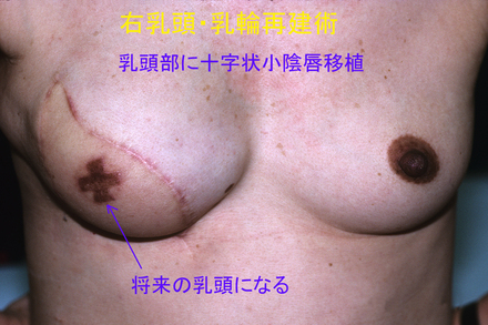 乳頭再建1.jpg