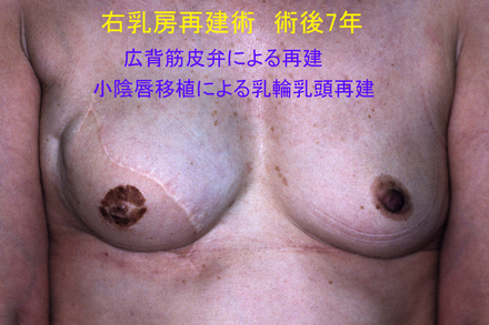 症例6術後7年.jpg