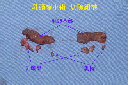 症例5切除組織.jpg