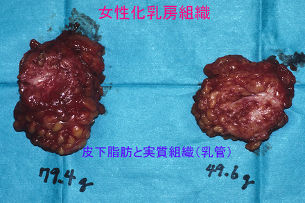 症例1摘出組織.jpg