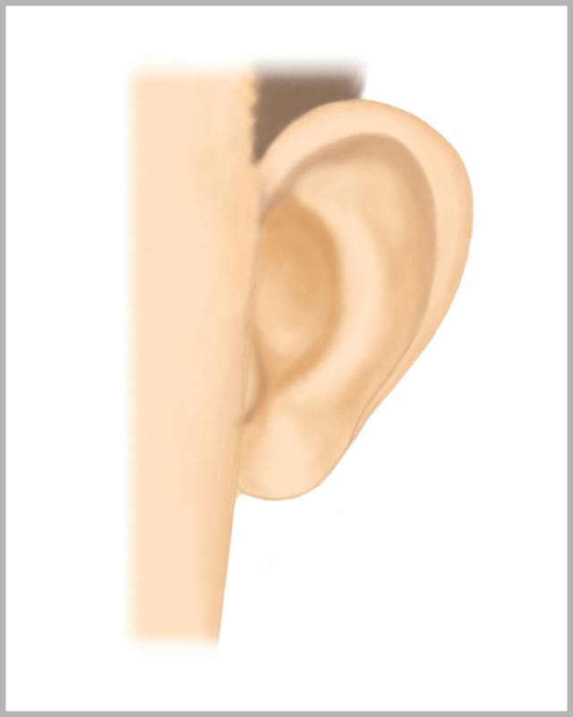 立ち耳形成術（立ち耳を治す）1