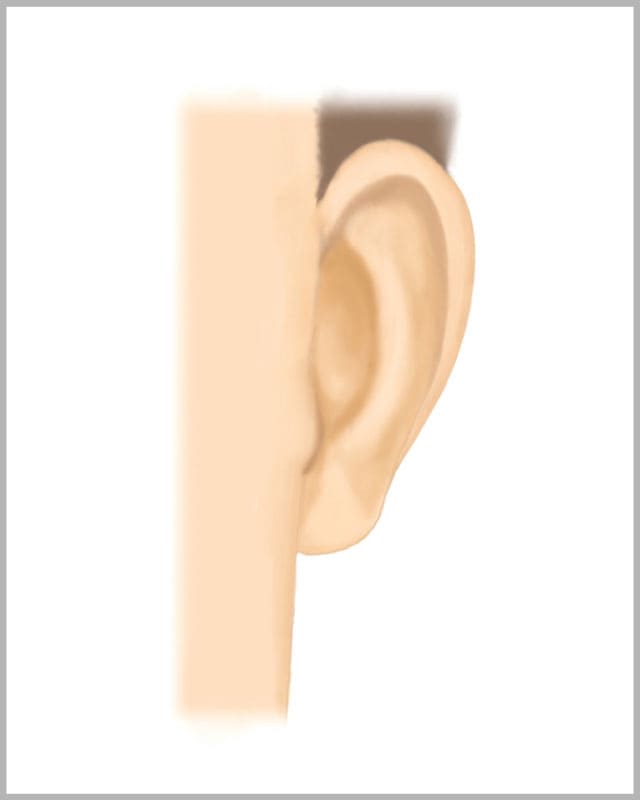 立ち耳形成術（立ち耳を治す）2