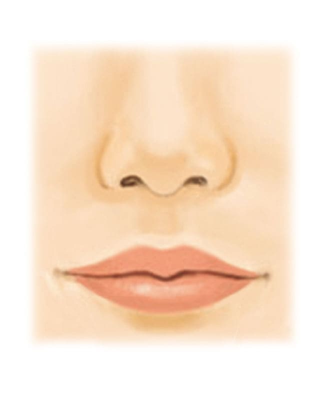 口唇縮小術（たらこ唇を治す、唇を薄くする）2