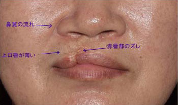 症例9　口唇裂術後修正手術 手術前