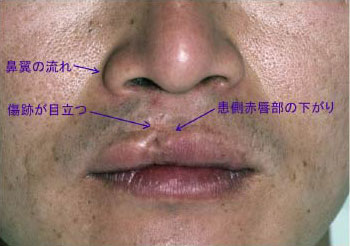 症例10　口唇裂術後修正手術 手術前