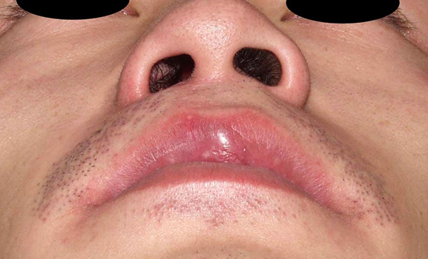 症例13　鼻翼変形（口唇裂術後）修正手術 手術後
