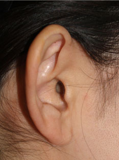 症例1　立ち耳形成術 手術前（右）