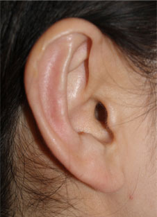 症例1　立ち耳形成術 手術後（右）