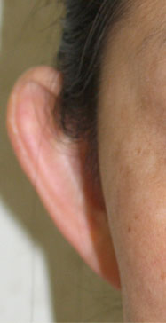 症例1　立ち耳形成術 手術前（右）