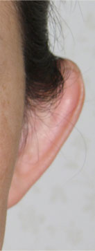 症例1　立ち耳形成術 手術前（左）