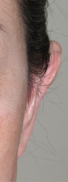 症例1　立ち耳形成術 手術後（左）